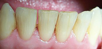 Dental Abrasions and Cracks - Implants, Wisdom tooth surgery, Root