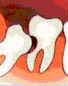 wisdom teeth removal bone fragments