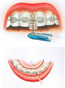 Why Your Orthodontist Changes Your Braces Wires - MEYARN Oral Care